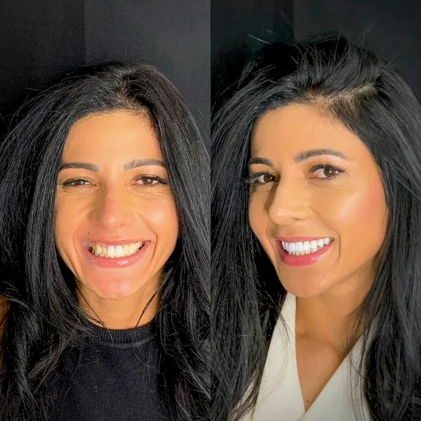 Paciente da Vicente Filho Odontologia antes e depois das lentes de contato dental